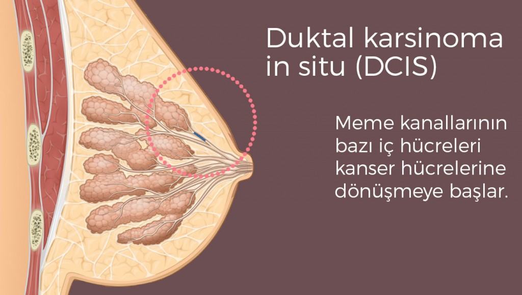 Meme Kanseri Tipleri Doç. Dr. Erkan Ozturk